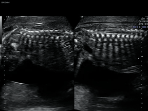 FetalMind fetal ultrasound animated demo